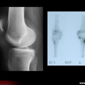 Spondylarthrite ankylosante: enthésite du genou